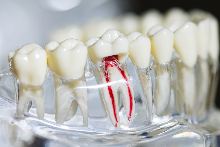 Close-up of dental model showing a tooth with a red root canal and transparent gum base