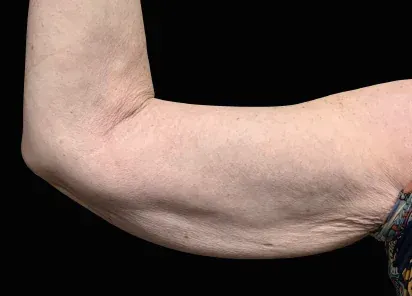 A close up of a woman 's arm with wrinkles on it.