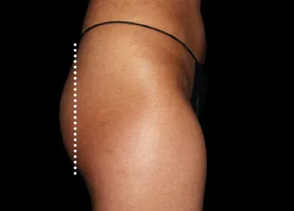 Butt before Emsculpt treatment