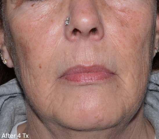 A close up of a woman 's face with the words after 4 tx on the bottom