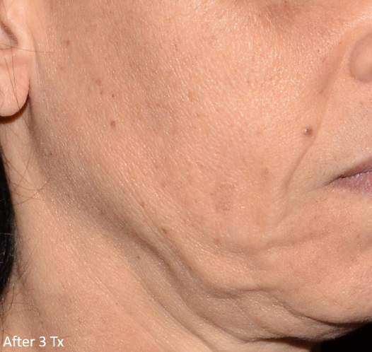 A close up of a woman 's face with the words after 3 tx on the bottom.