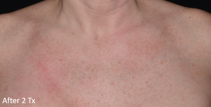 A close up of a woman 's chest with the words after 2 tx on the bottom