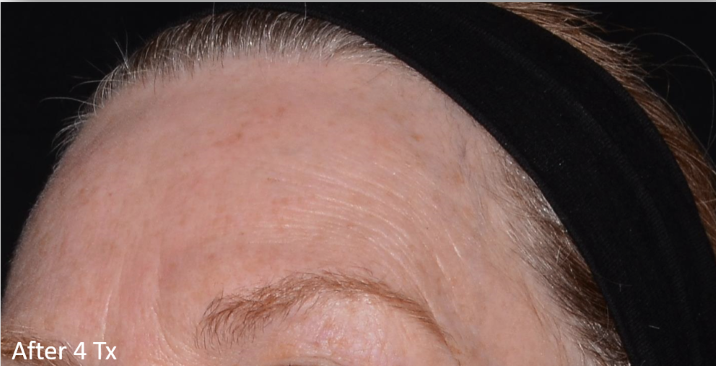 A close up of a woman 's forehead with a black headband.