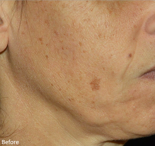 A close up of a woman 's face with spots on it.