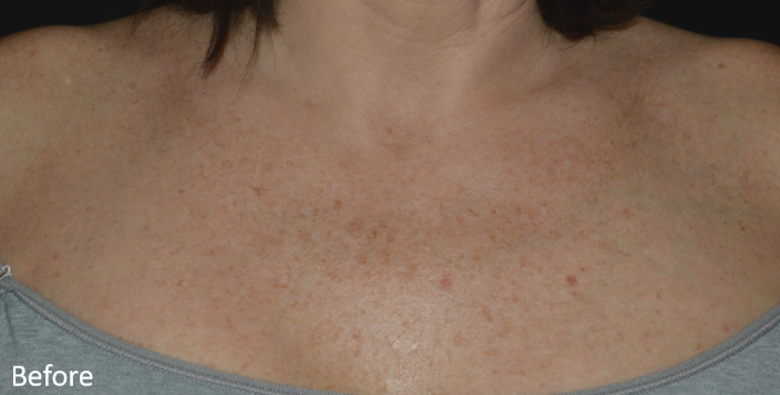 A woman 's chest with a lot of freckles on it.