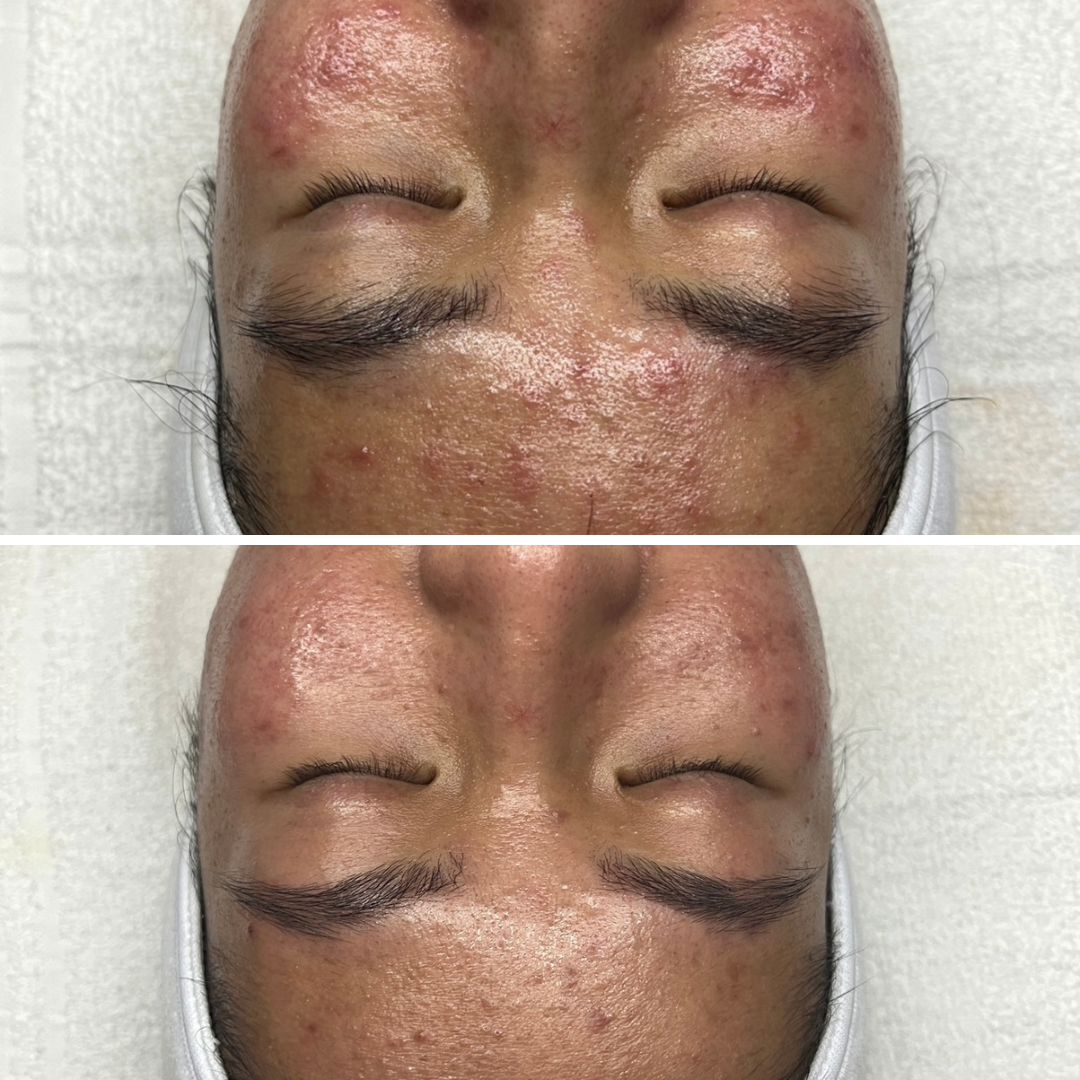 Side-by-side comparison of a person's face. The top shows a red, irritated complexion. The bottom shows improved skin.