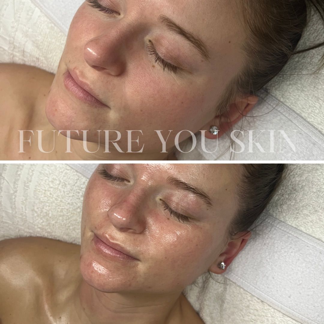 Two photos of a person's face before and after a skincare treatment, glowing skin.