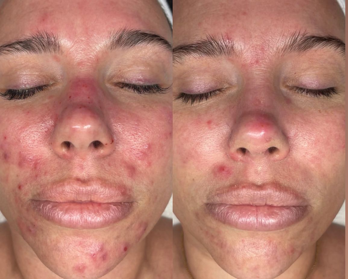 Discover how often you should really get a facial for clear, glowing, healthy skin. Learn the best treatment schedule for acne, anti-aging, and maintenance + book your customized facial at Future You Skin in Gahanna, Ohio.