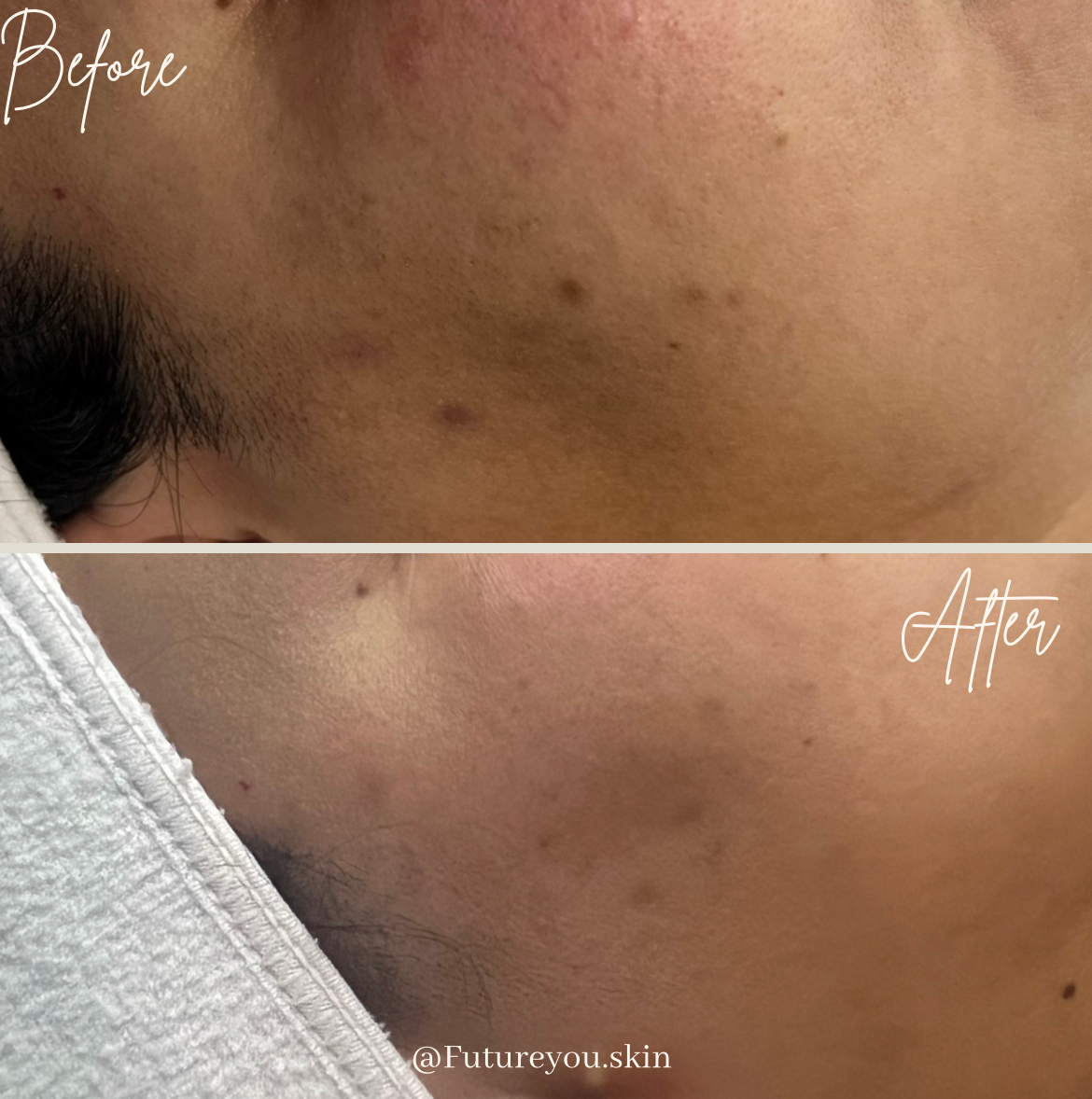 Side-by-side comparison of skin before and after treatment, showing fewer blemishes and improved skin tone.