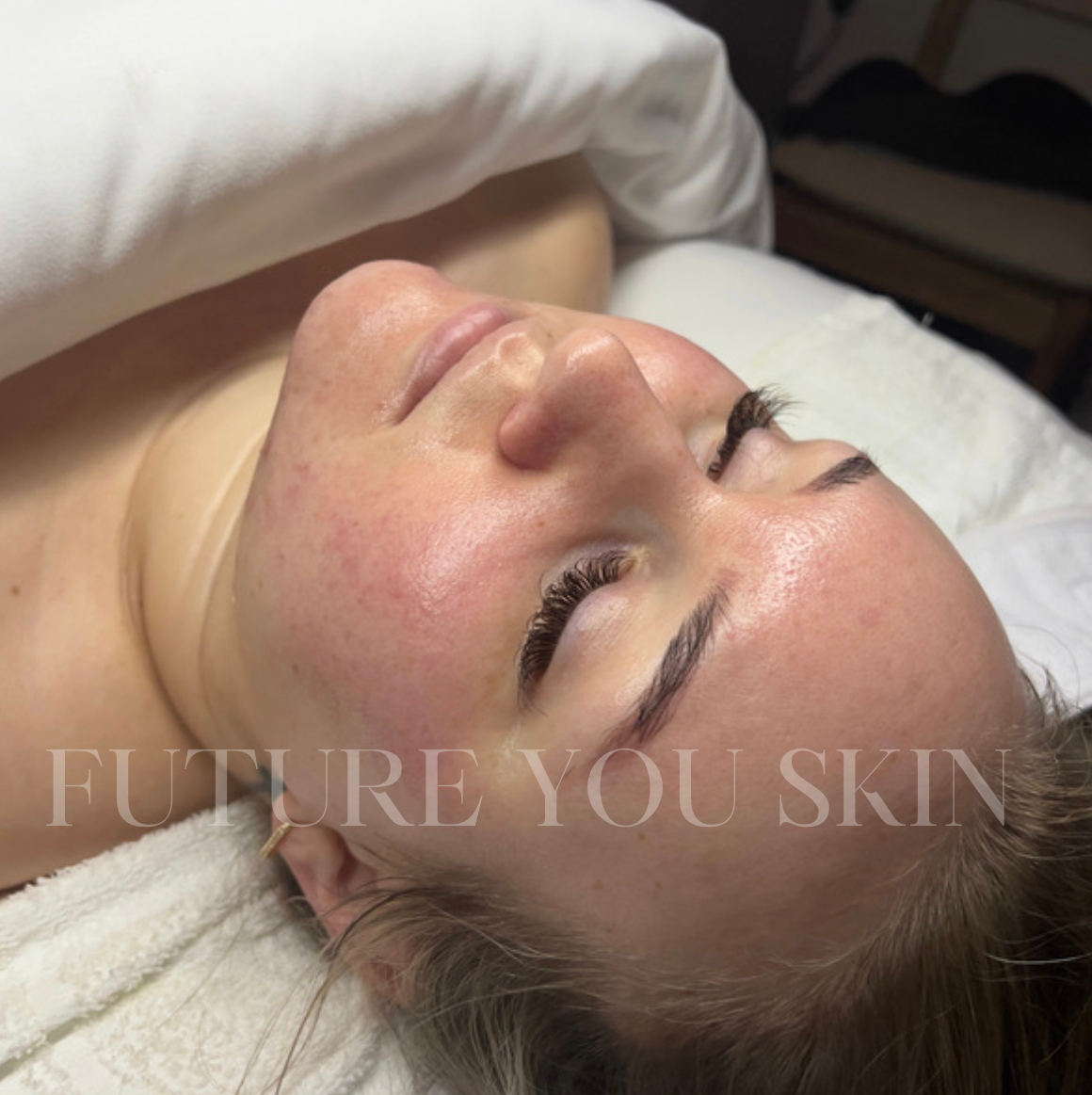 Woman's face close up on a treatment table. She has closed eyes and fair skin with visible redness. The setting appears to be a spa.