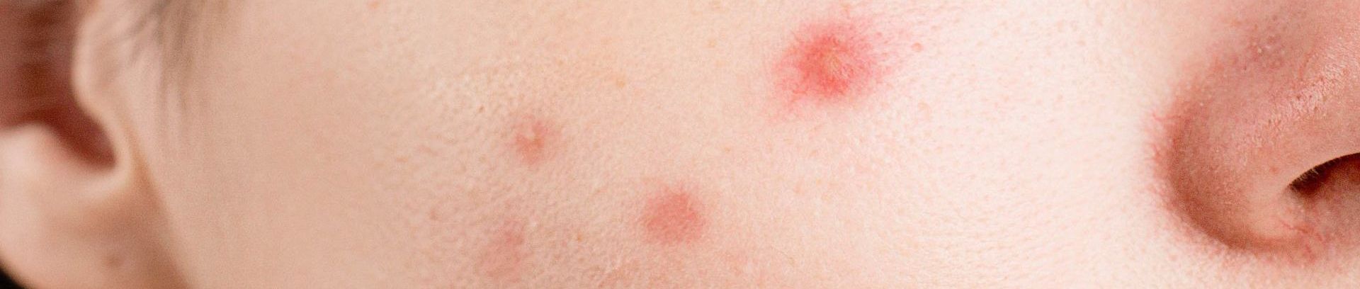 Acne