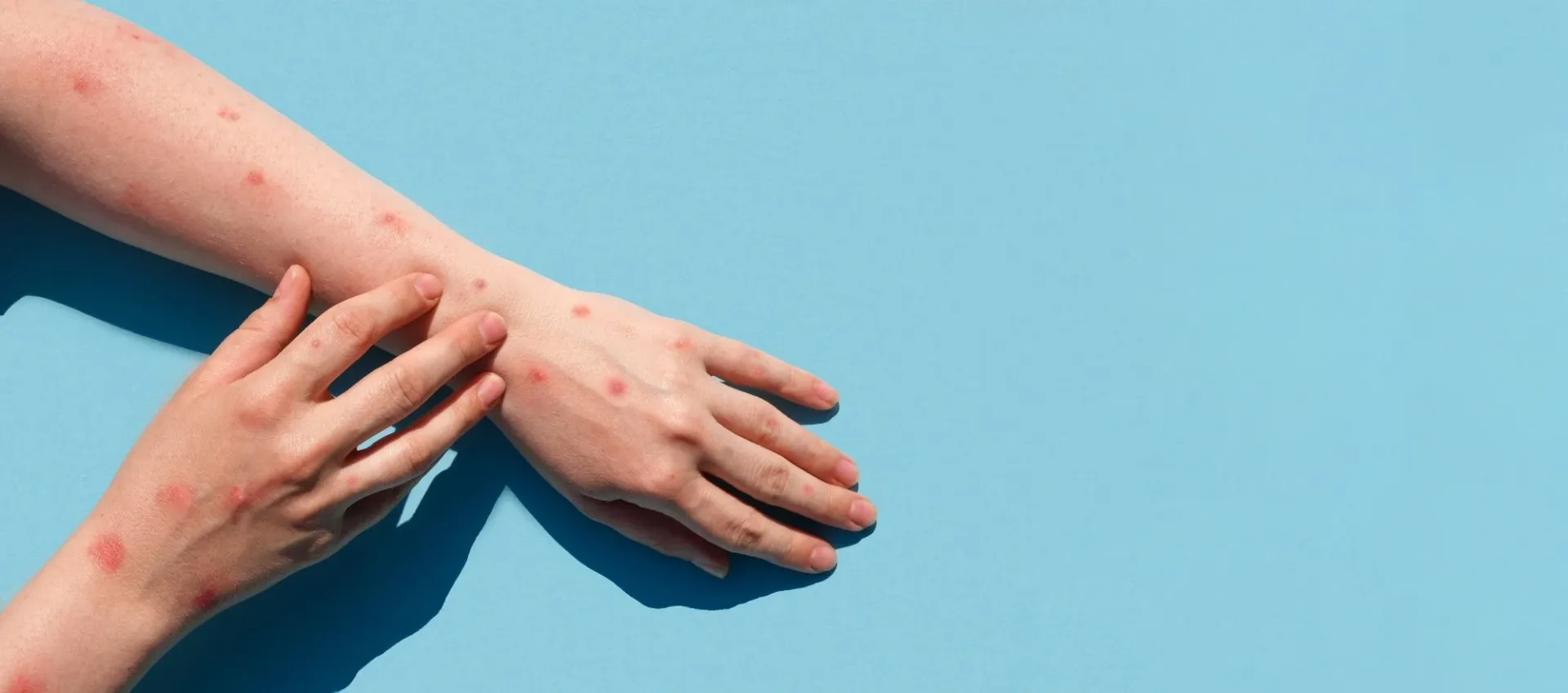 A person is scratching their arm with red spots on it.