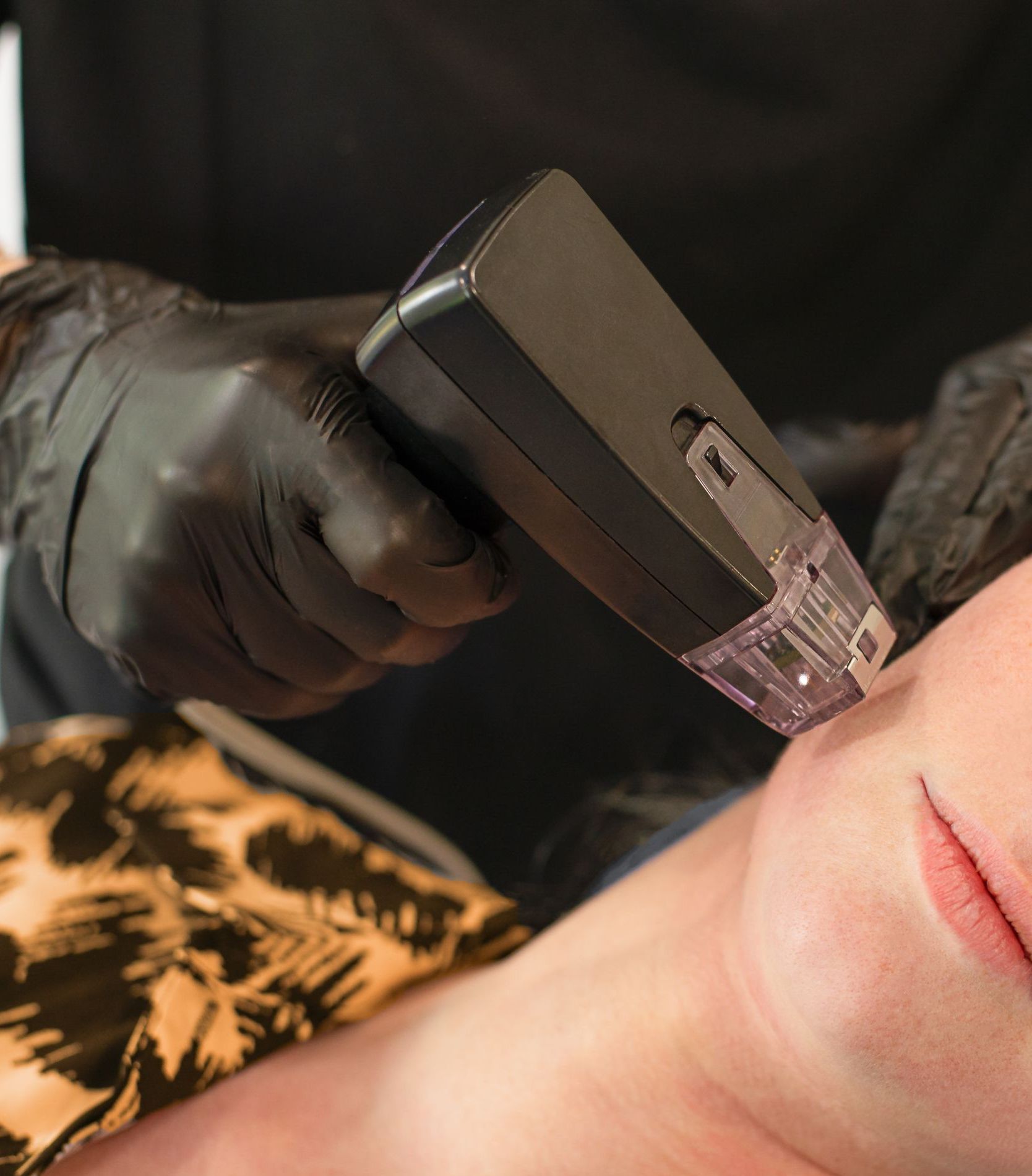 A woman is getting a laser treatment on her face