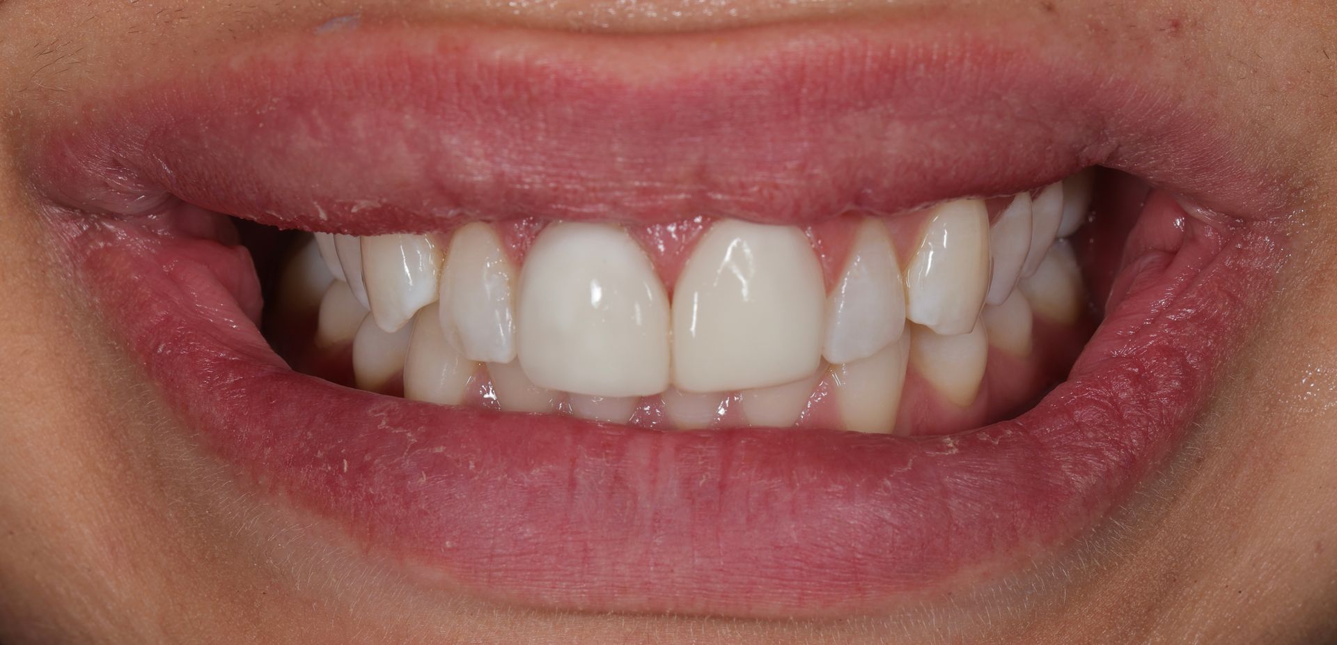 Etter edge bonding — naturlig og harmonisk tannform
