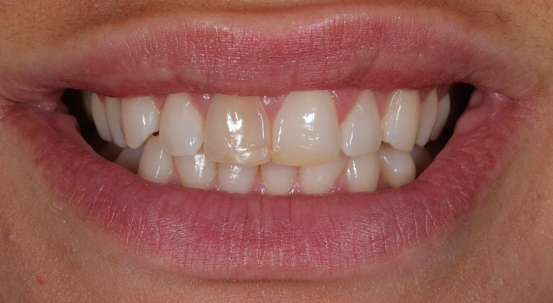 Før edge bonding — uregelmessig tannform og kanter