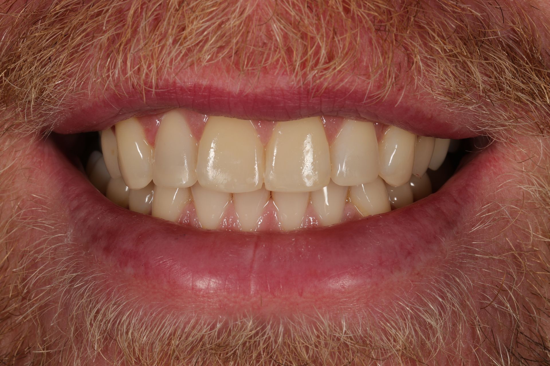 Etter edge bonding — jevnere og mer symmetrisk smil