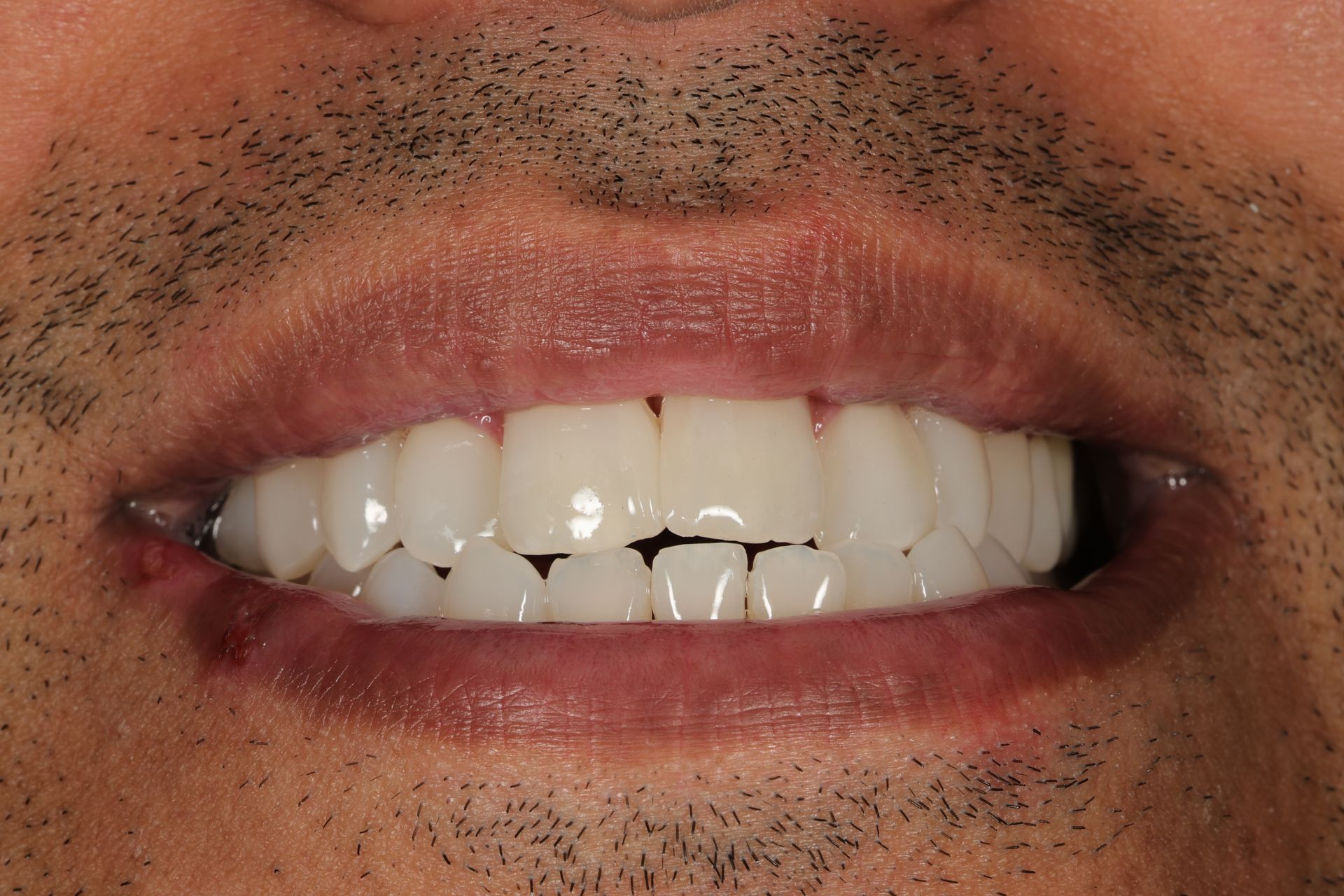 Etter edge bonding og tannbleking — hvitere og jevnere smil hos Tannlegene på Sinsen