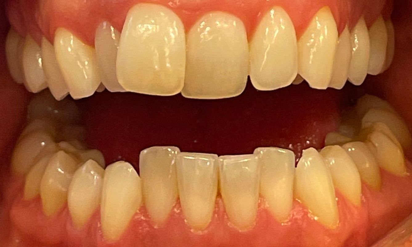 Før og etterbilder etter Invisalign