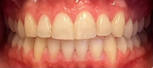 Etter Invisalign: rette fortenner hos samme pasient