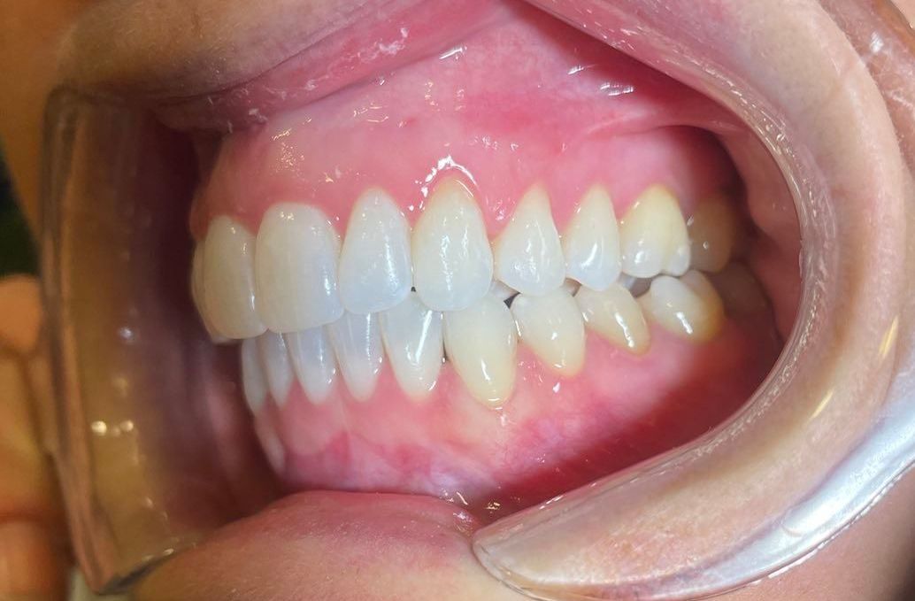 rette tenner med Invisalign