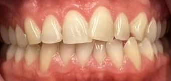 Før Invisalign: trangstilte fortenner hos en pasient ved Tannlegene på Sinsen