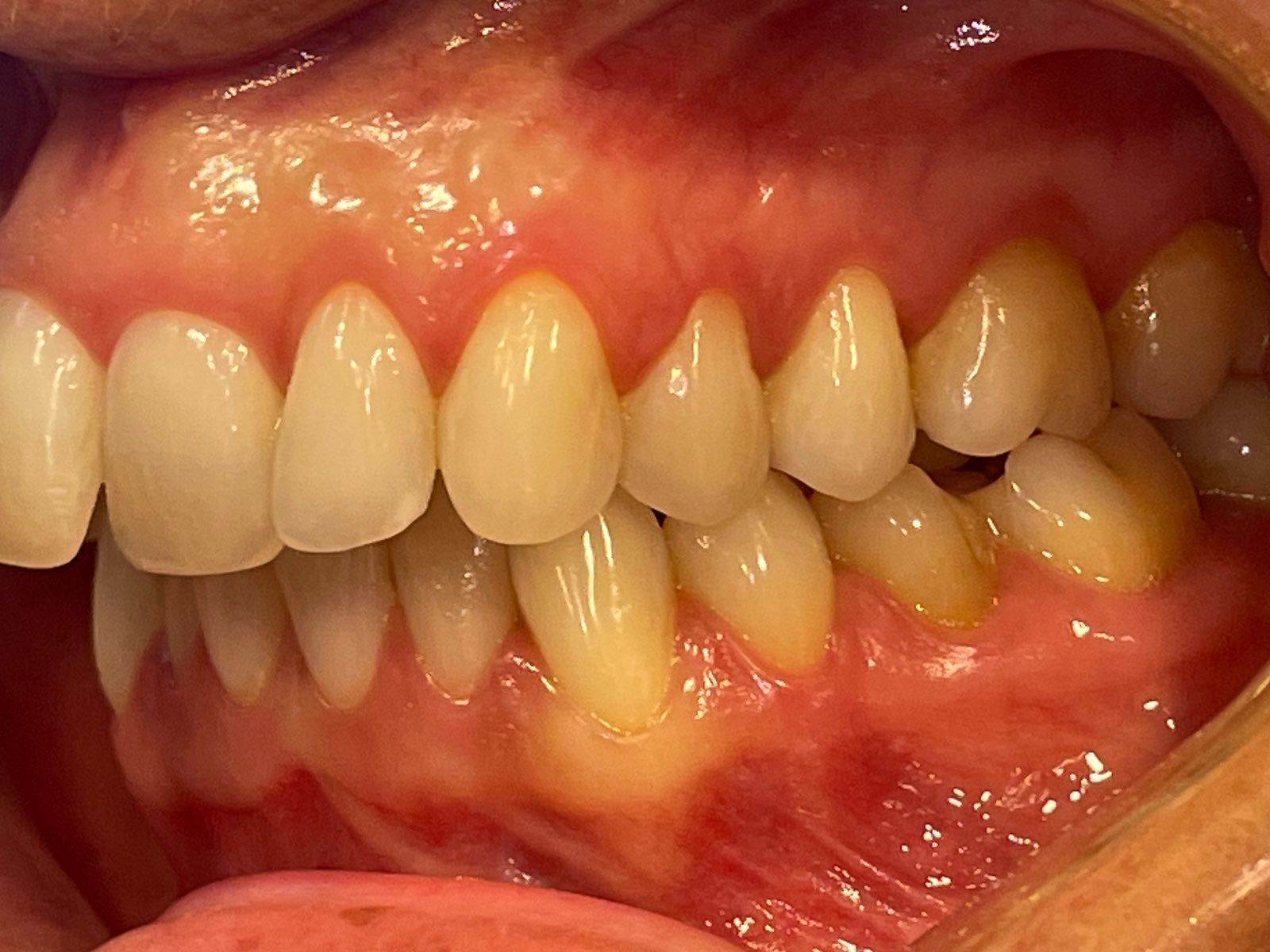 rette tenner med Invisalign