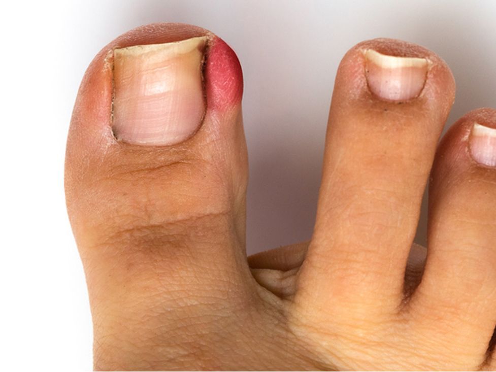 INGROWN TOENAILS