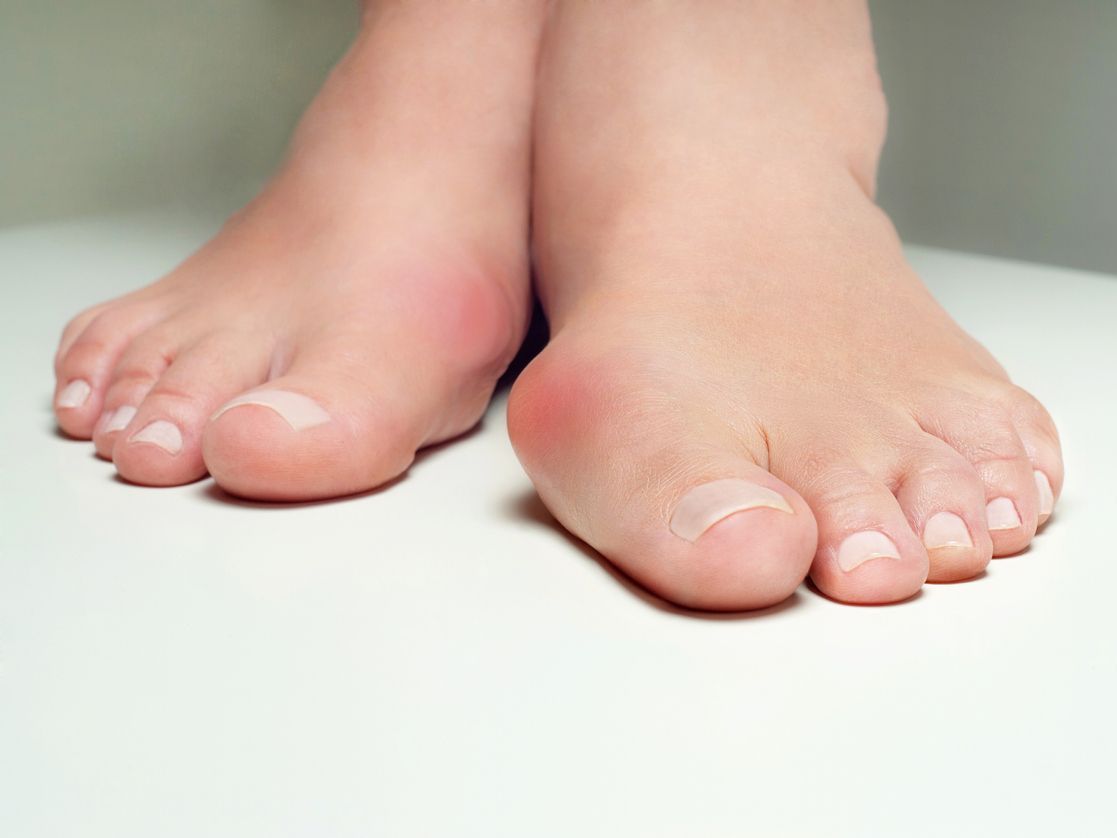 BUNIONS