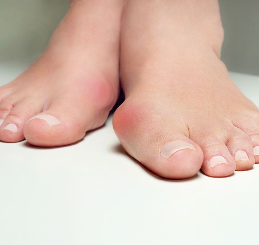 BUNIONS