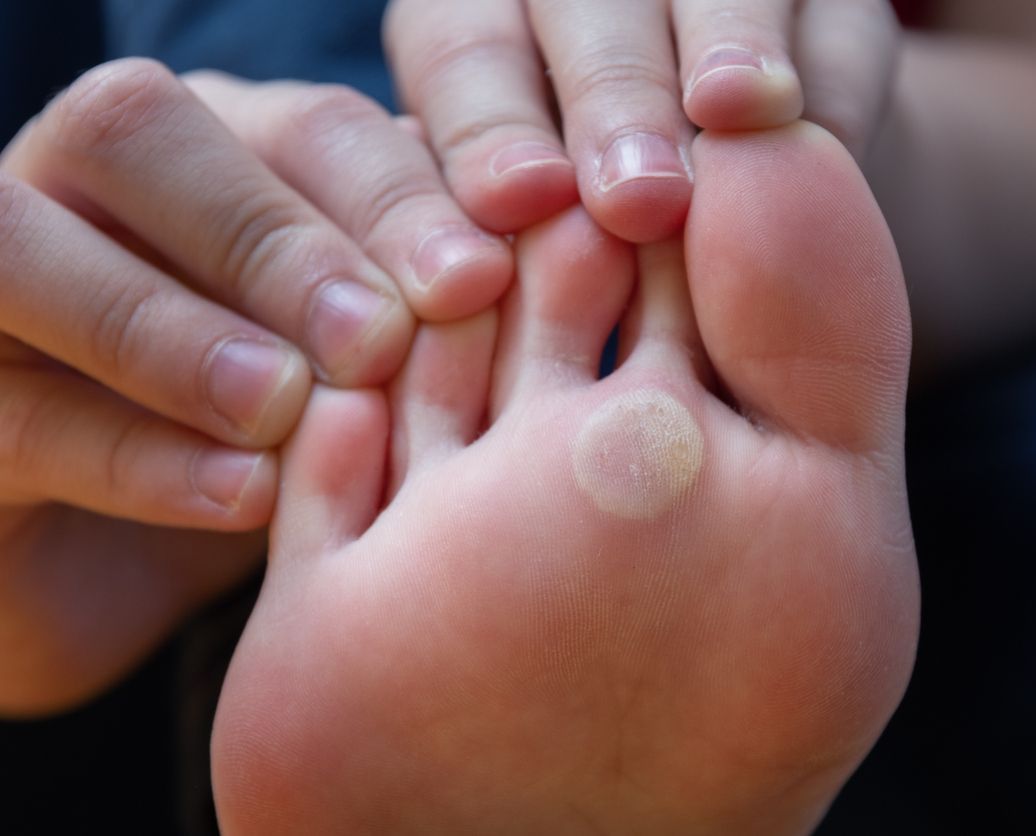 PLANTAR WARTS