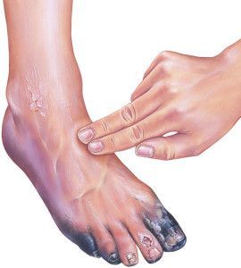 PERIPHERAL VASCULAR DISEASE