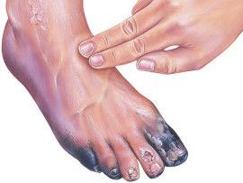 PERIPHERAL VASCULAR DISEASE