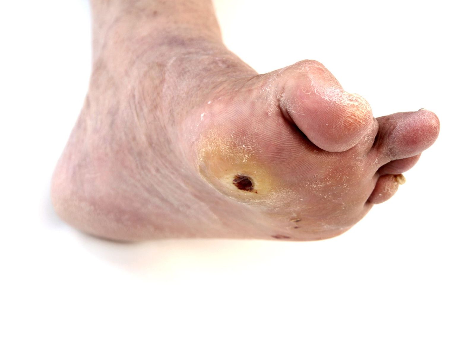 ULCERS AND INFECTIONS
