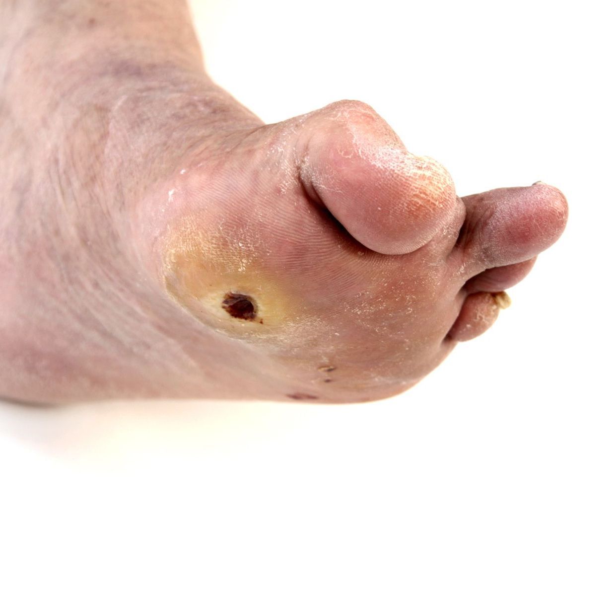 ULCERS AND INFECTIONS