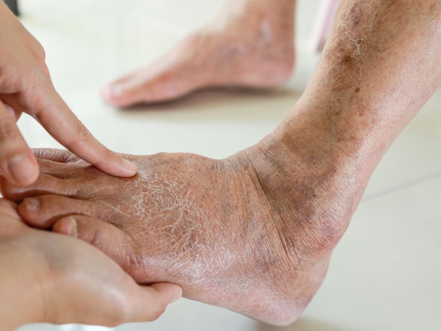 diabetic-foot