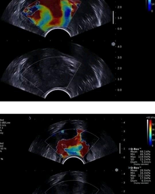 ELASTOSONOGRAFIA