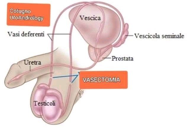 VASECTOMIA