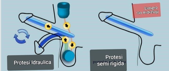 PROTESI PENIENE