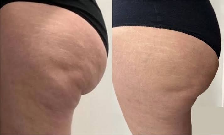 An Artemis T-Shape 2 before and after photo of a woman's glutes.