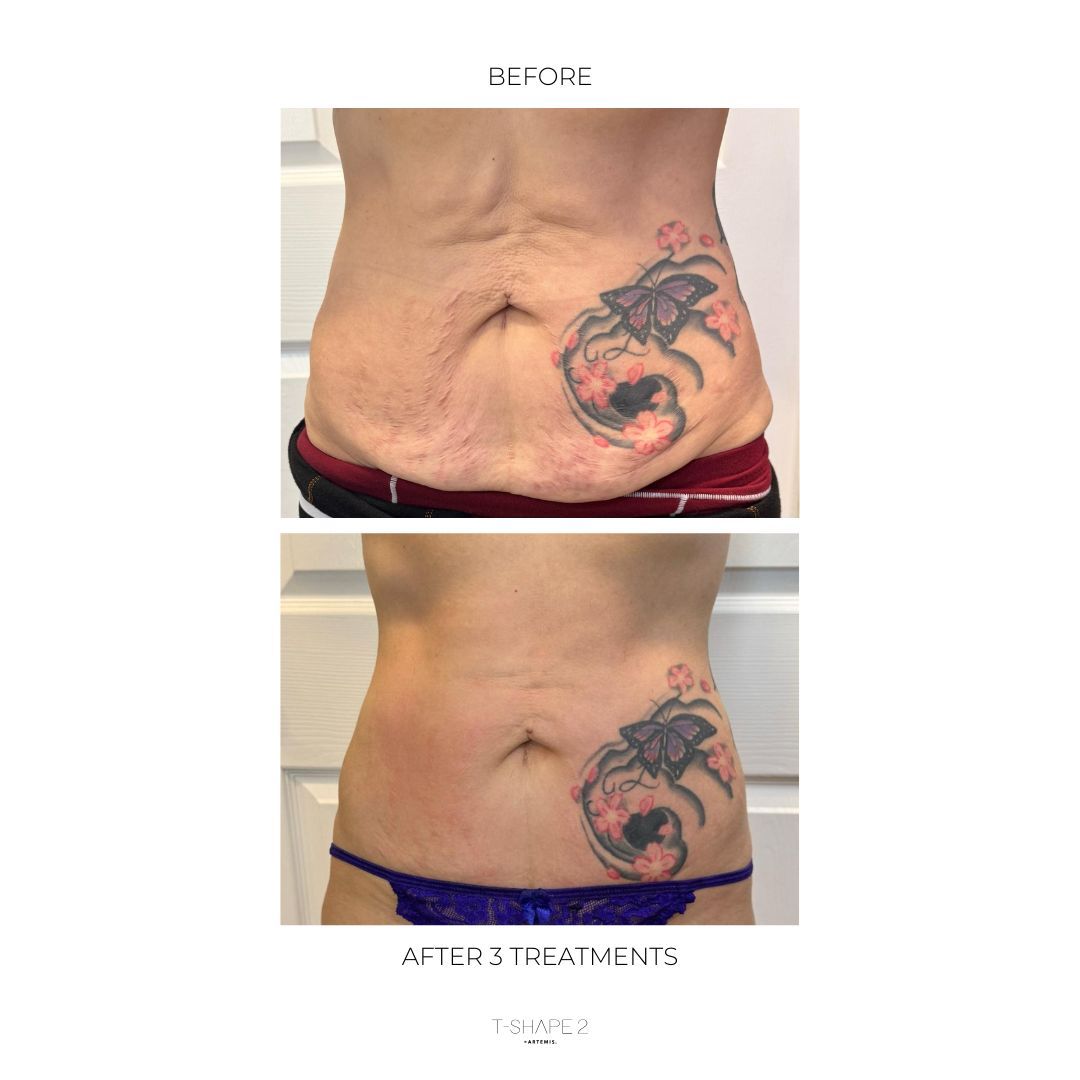 An Artemis T-Shape 2 before and after photo of a woman's belly.