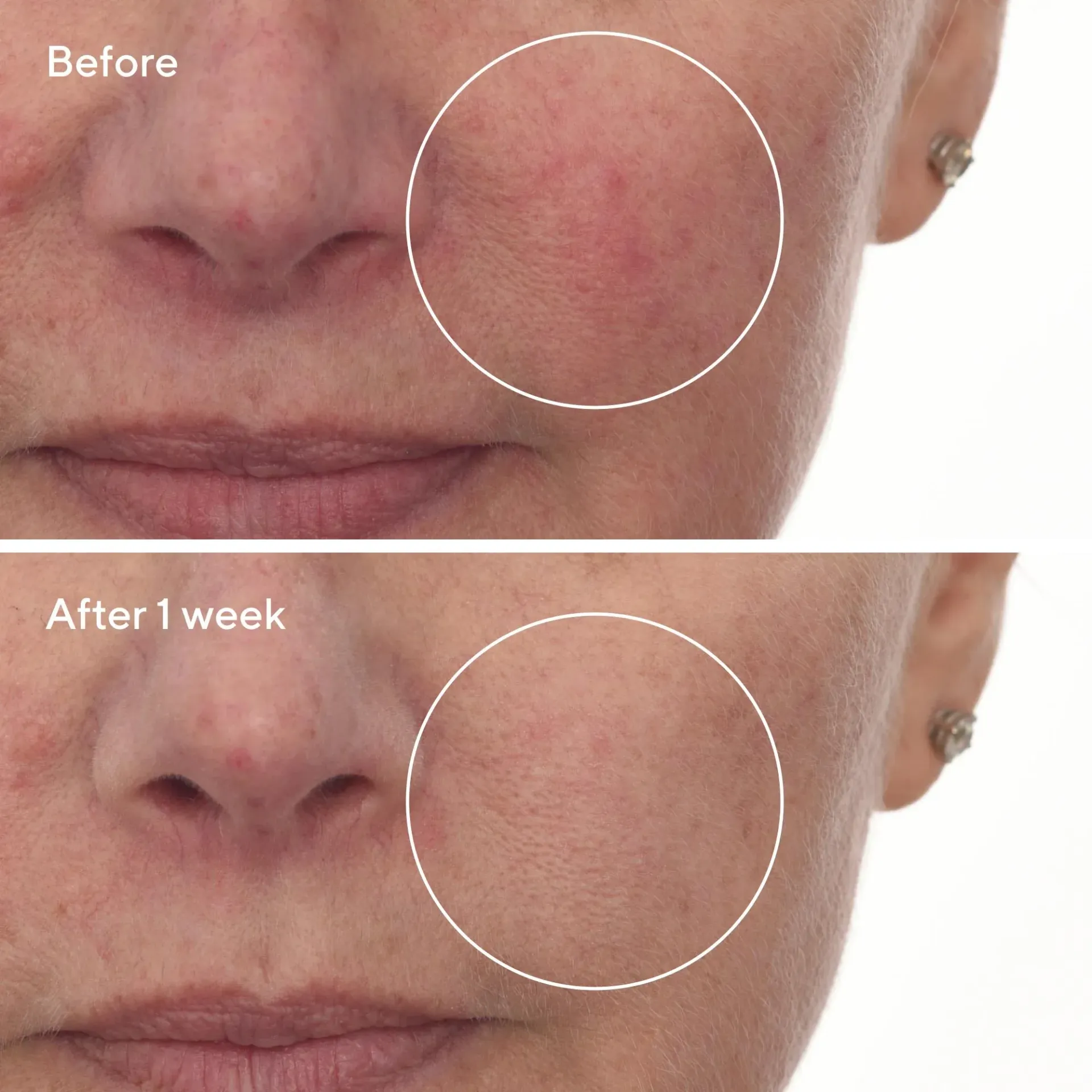 Aesthetician performing a gentle calming facial treatment for sensitive skin