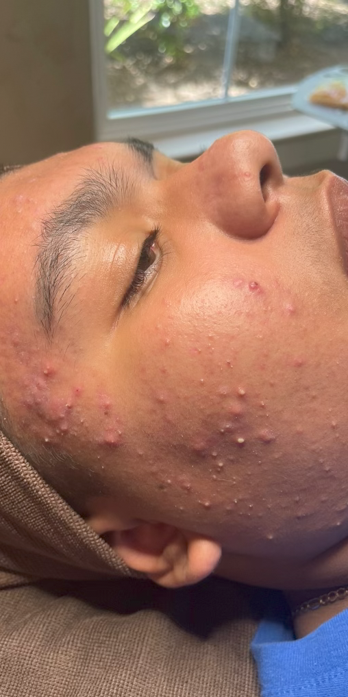 Teen Acne Facial Before