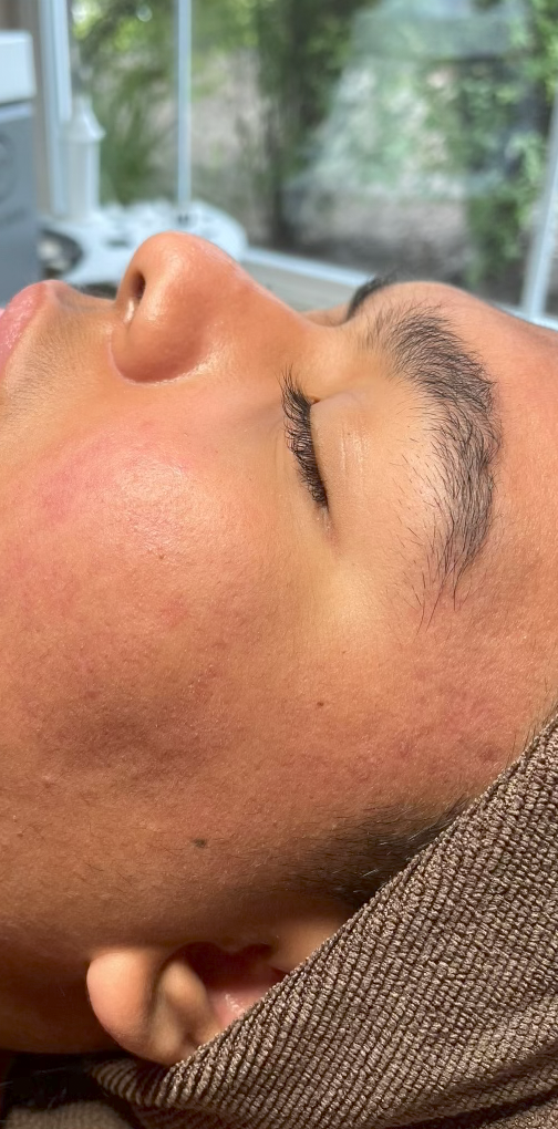 Teen Acne Facial After