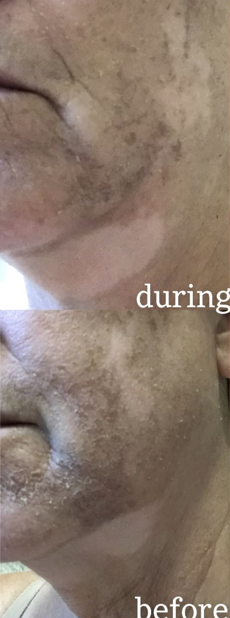 Before Corrective Peel 