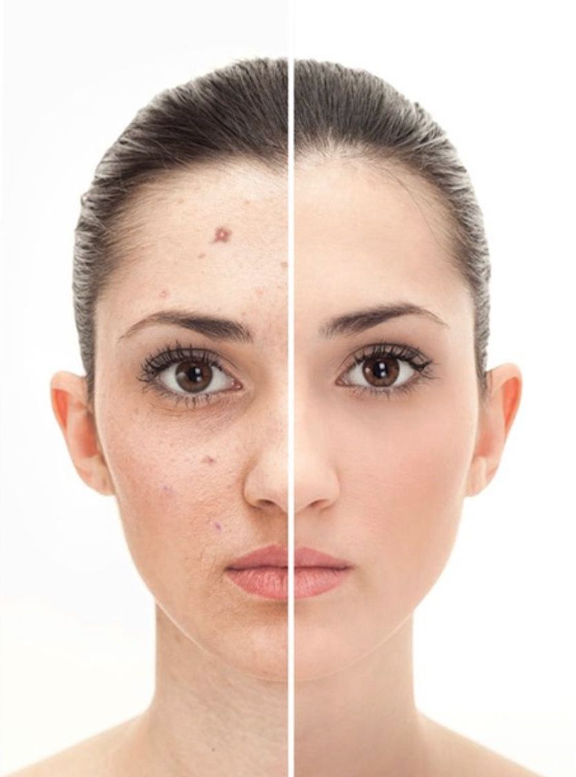 Before and After Lamprobe Growth Treatment