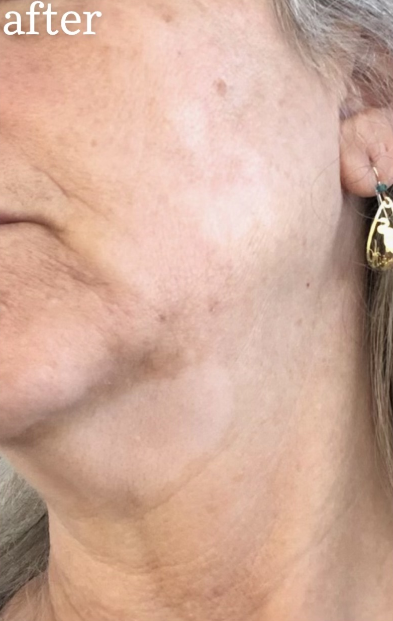 After Corrective Peel Collection Peel series