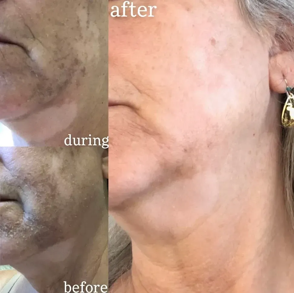 Vitiligo Cosmedix Peel Before and After