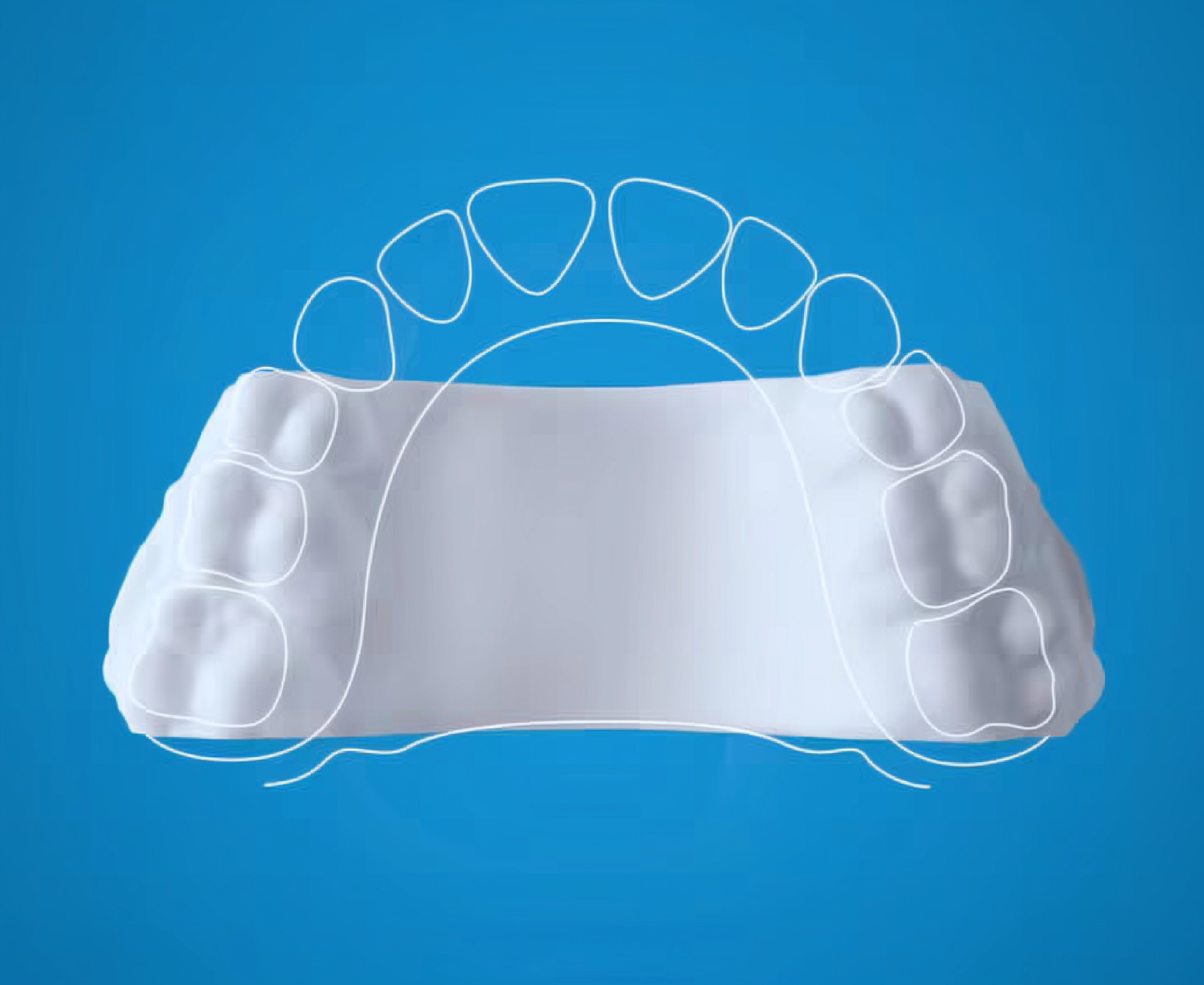 Dental impression model with overlaid white tooth outlines.