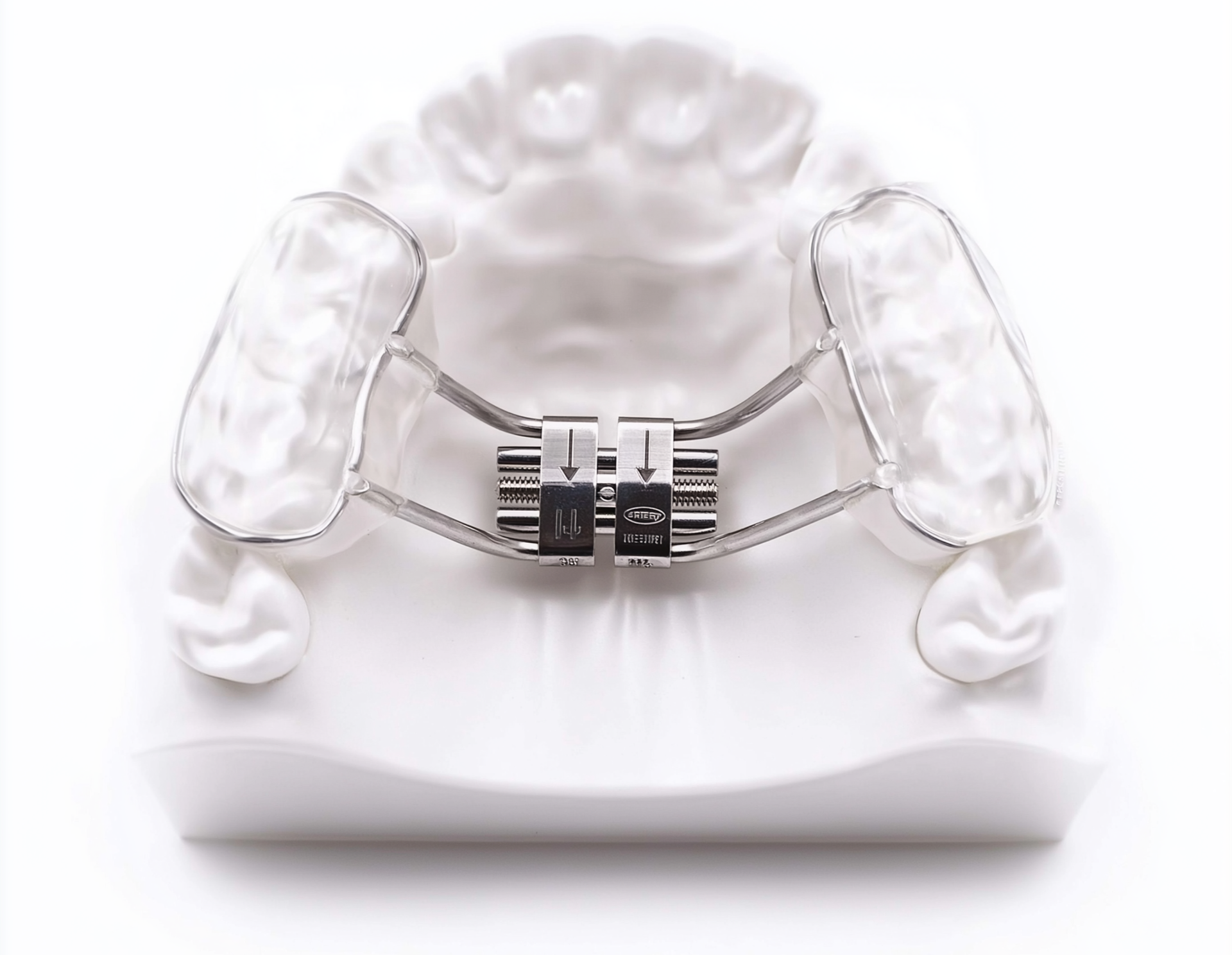 Dental expander appliance on a white dental model, used to widen the upper jaw.
