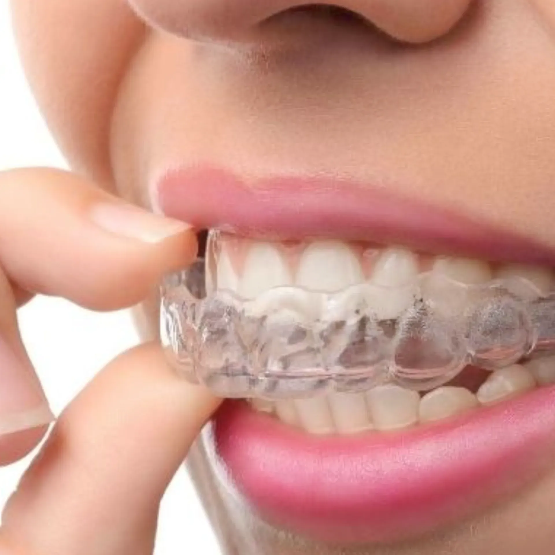 A woman is wearing a clear retainer on her teeth.